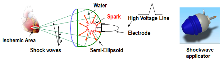 Heart Treatment Without Bypass Surgery In Pune