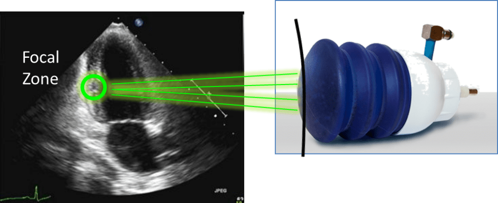 Heart Blockage Treatment Without Surgery